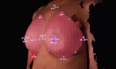 3D볼륨체크 수술 후 이미지