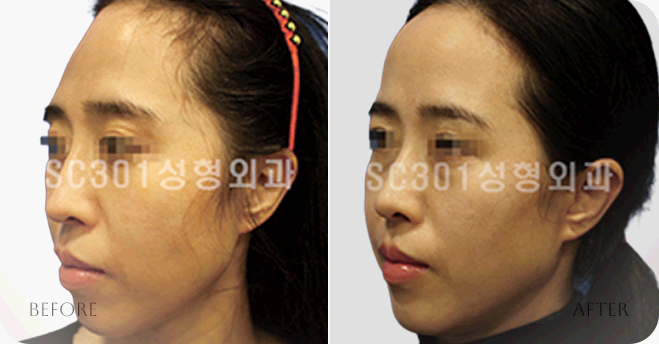 sc301의원 얼굴성형 전후사진 로그인 후 이미지