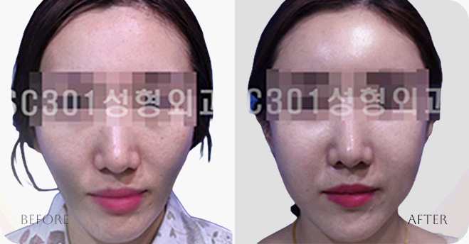sc301의원 얼굴성형 전후사진 로그인 후 이미지
