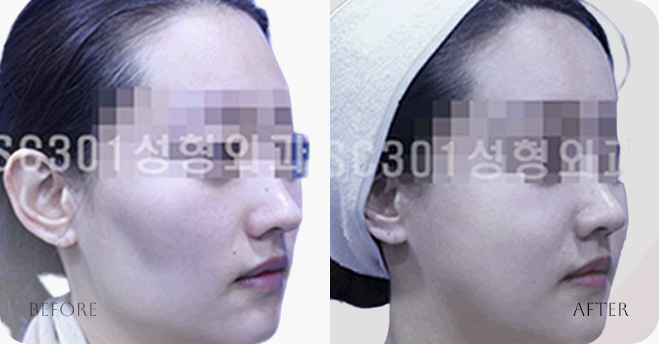 sc301의원 얼굴성형 전후사진 로그인 후 이미지