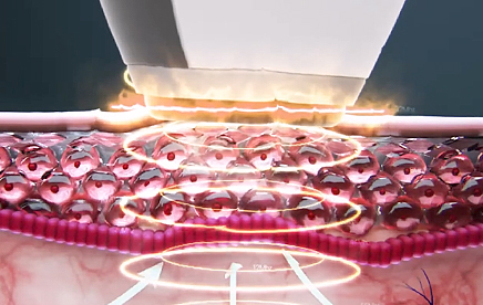 스마트 니들리프팅 시술 원리 세번째 이미지