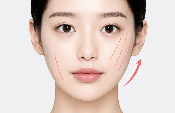 svf 광셀린지 리프팅 시술 이미지